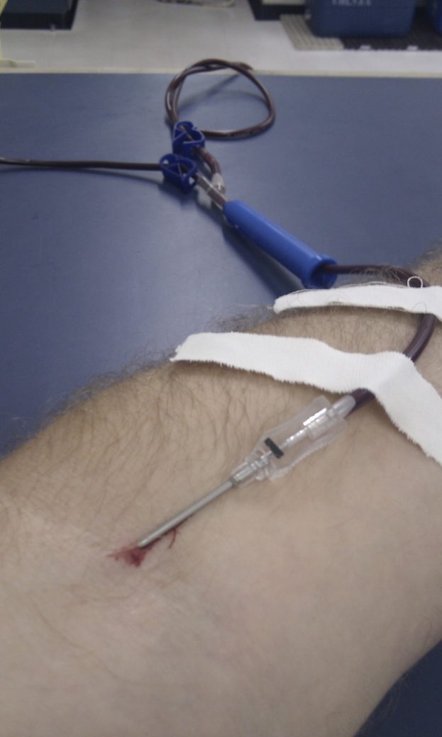 Eine Hand mit einem Kochsalzschlauch und einer Nadel sowie mehreren Pflastern auf der Haut.